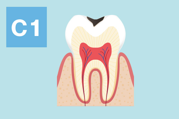 歯の表面のむし歯を説明するイラスト