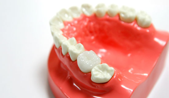 奥歯の治療中の模型