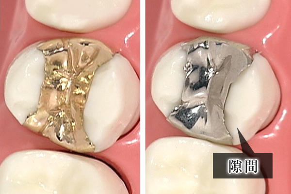 ゴールドと銀歯の比較画像