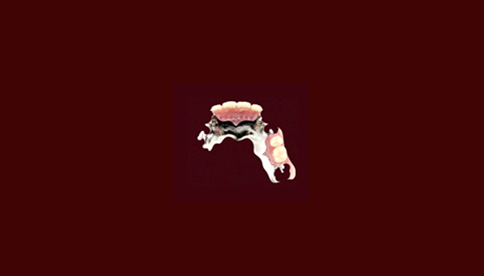 チタン床義歯の画像