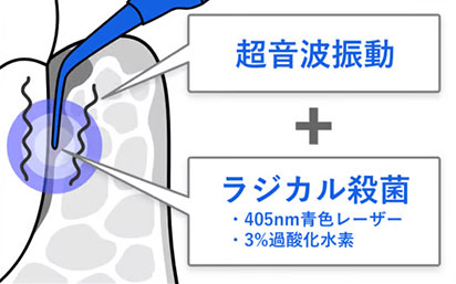 ブルーラジカル治療 ブルーラジカル治療